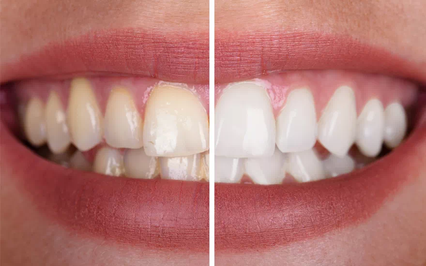 zmiana odcienia zębów