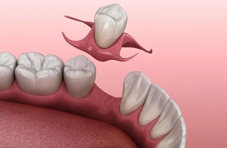 dopasowywanie zęba do protezy